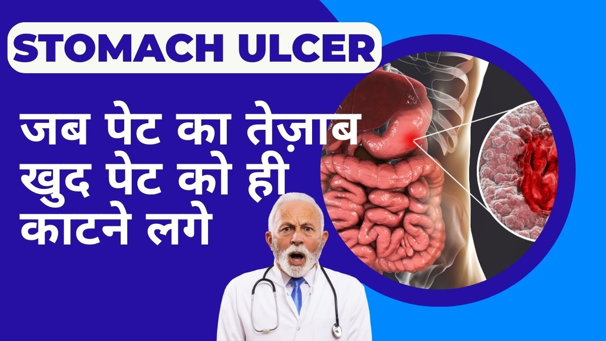Stomach Ulcer